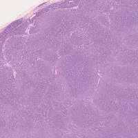 Follicular lymphoma